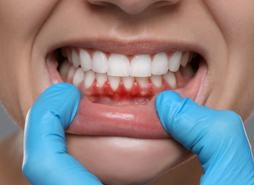 Gum Disease Treatment